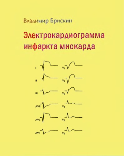 Электрокардиограмма инфаркта миокарда