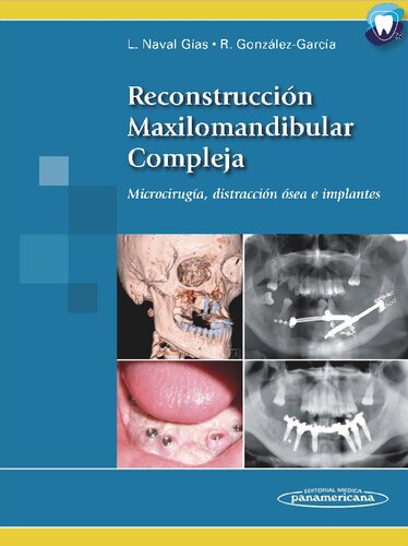 Reconstrucción maxilomandibular compleja. Microcirugía, distracción ósea e implantes