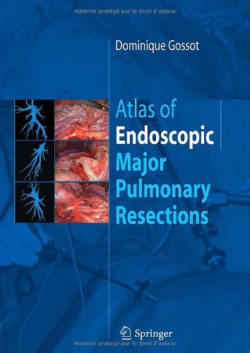 Atlas of Endoscopic Major Pulmonary Resections