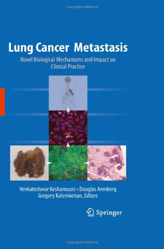 Lung Cancer Metastasis: Novel Biological Mechanisms and Impact on Clinical Practice